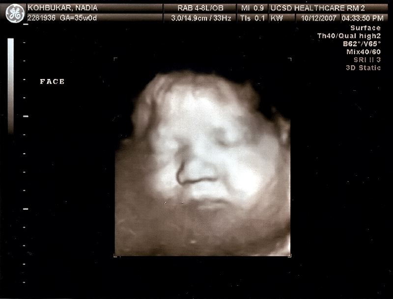 Thea 3D Front View- 35 Weeks
