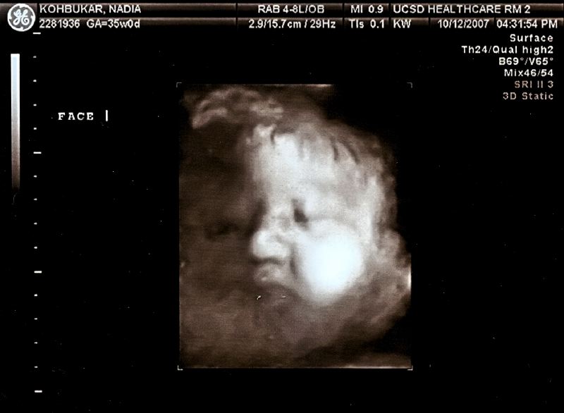 Thea 3D Profile- 35 Weeks