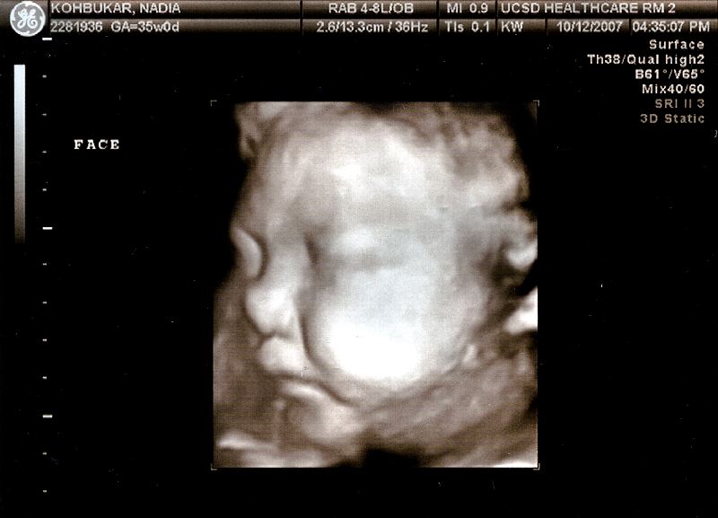 Thea 3D Profile- 35 Weeks