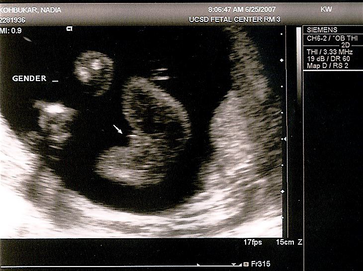 Thea Butt, Feet, and Gender Observed - 20 weeks